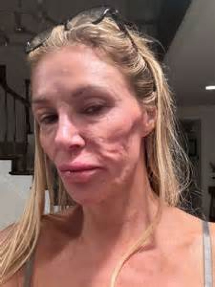 Brandi Glanville Hospitalized With Mysterious Infection — See Her Brutal Hand Injury