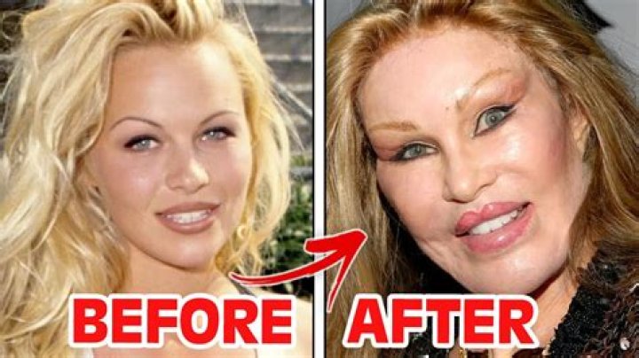 Stars With Botched Procedures – Hollywood Life